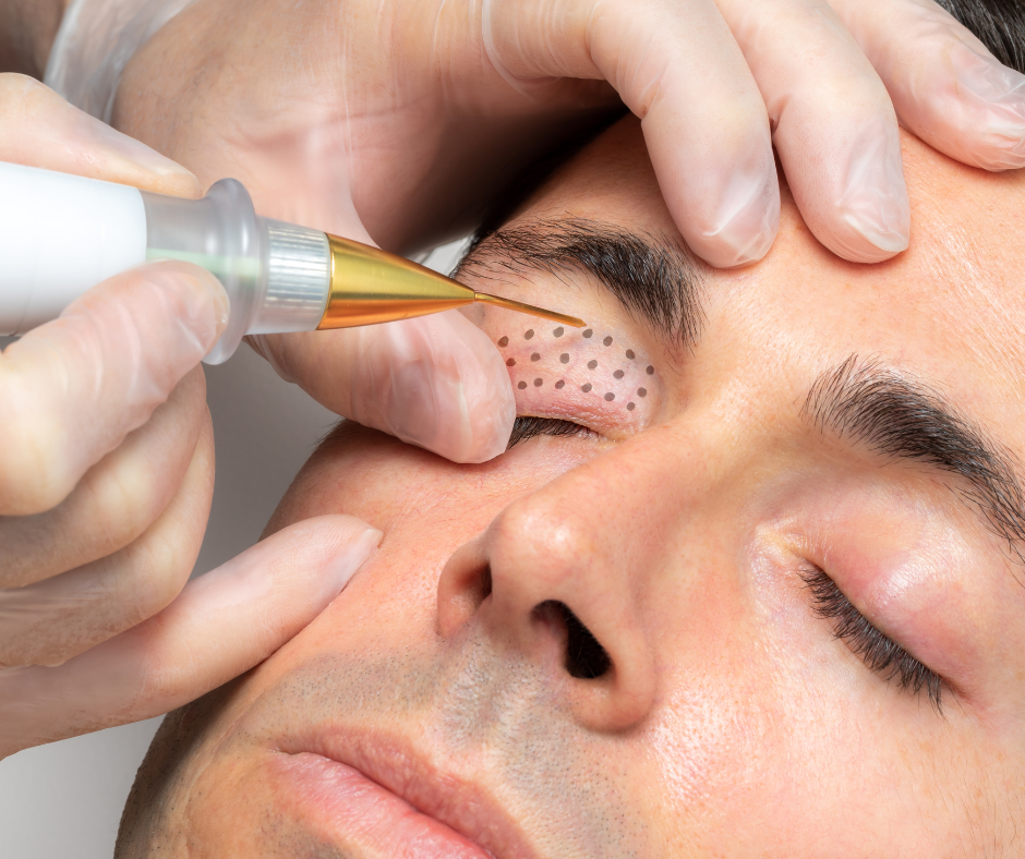 A Client receiving a Fibroblast treatment by a trained practitioner.