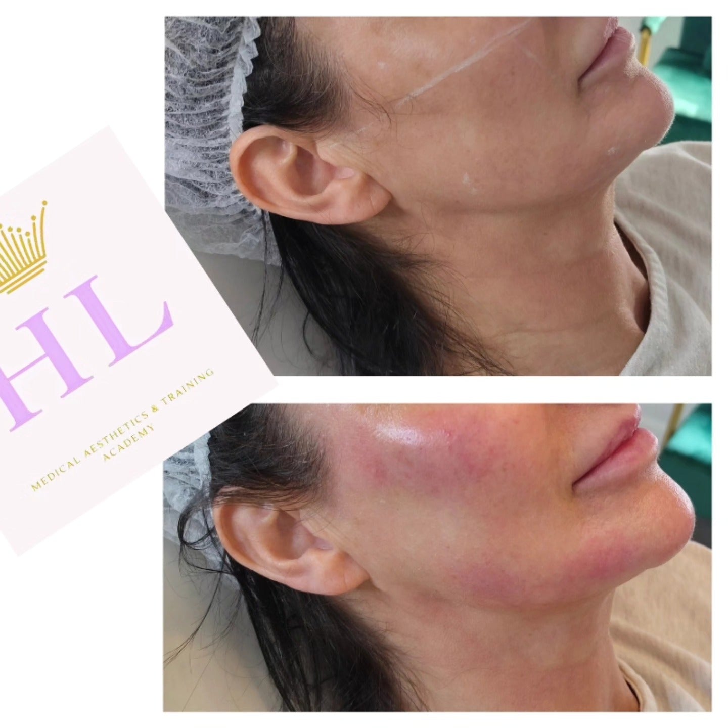 A HL Aesthetics Client in Darlington receiving treatment, showing before and after photos.