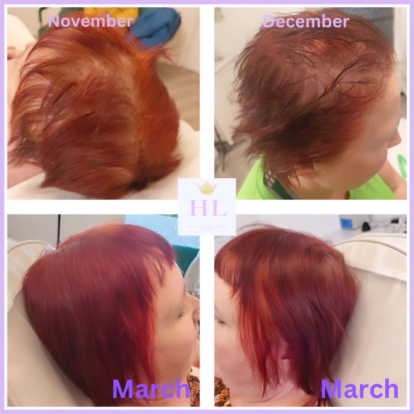 A HL Aesthetics Client in Darlington receiving PRP treatment, showing before and after photos.