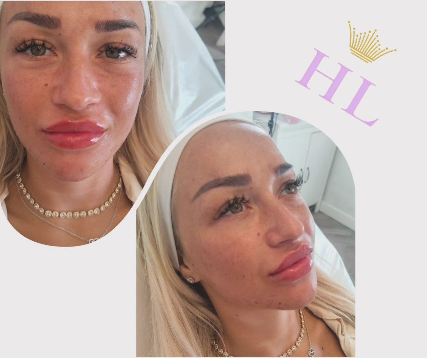 A HL Aesthetics Client in Darlington receiving treatment, showing before and after photos.
