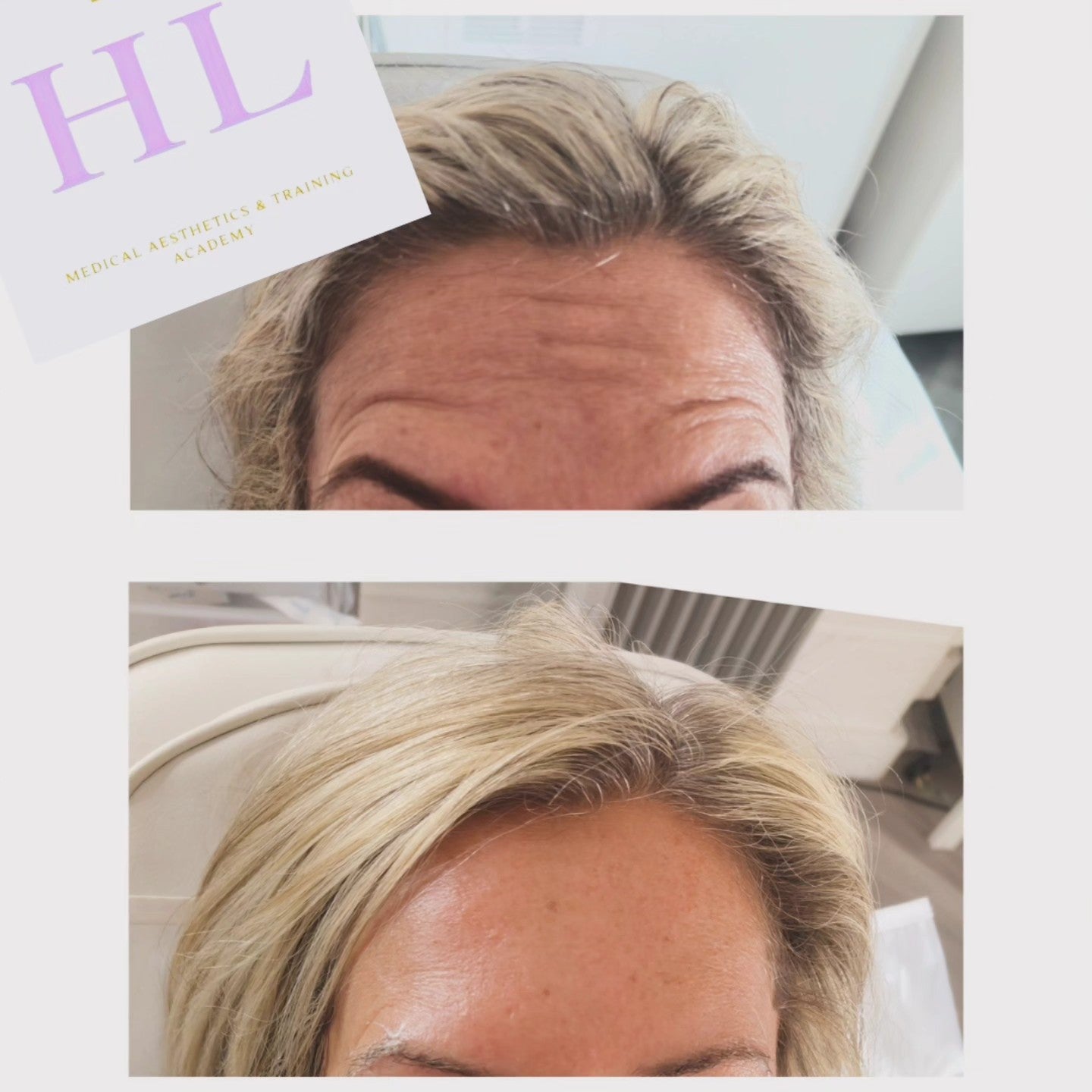 A HL Aesthetics Client in Darlington receiving treatment, showing before and after photos.