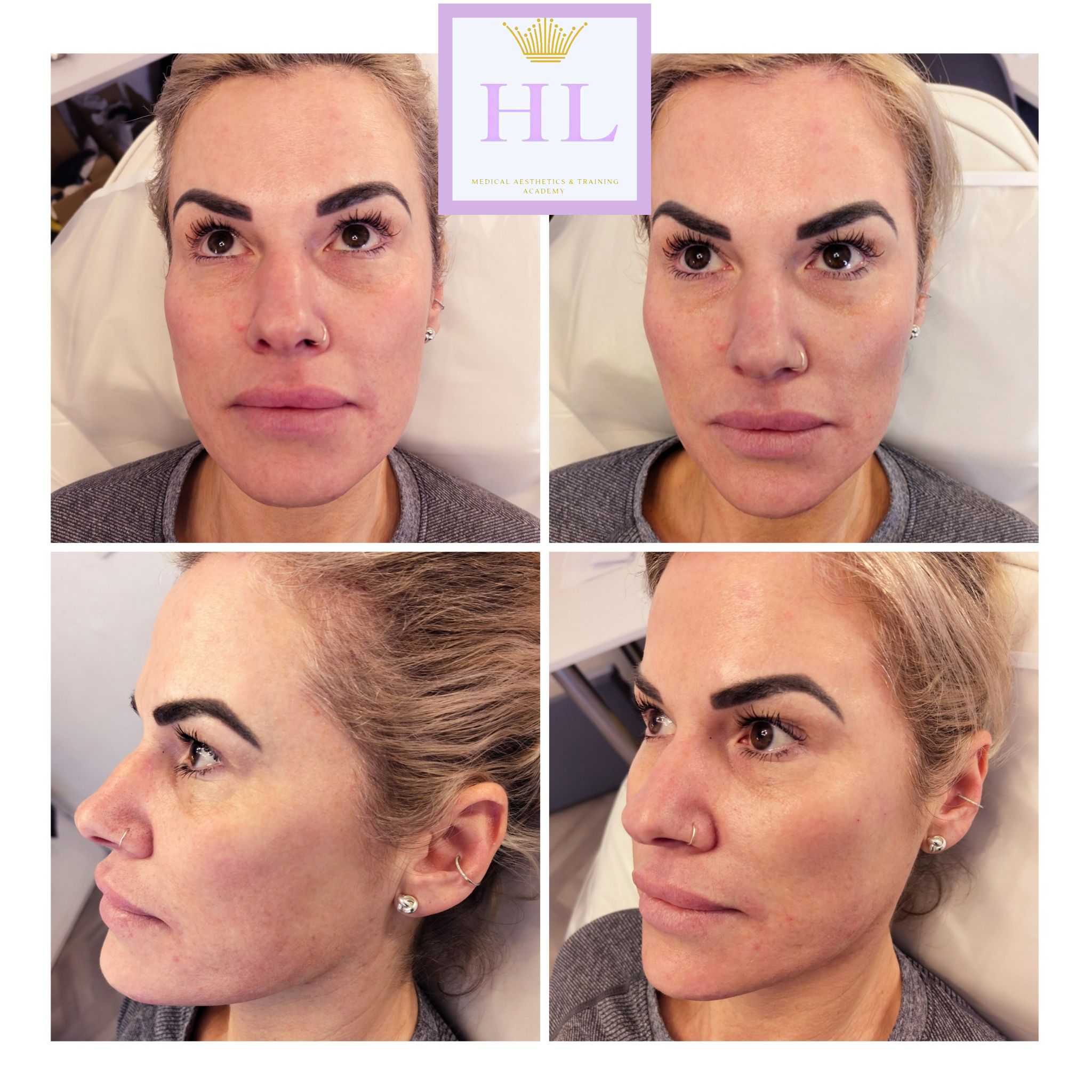 A HL Aesthetics Client in Darlington receiving treatment, showing before and after photos.