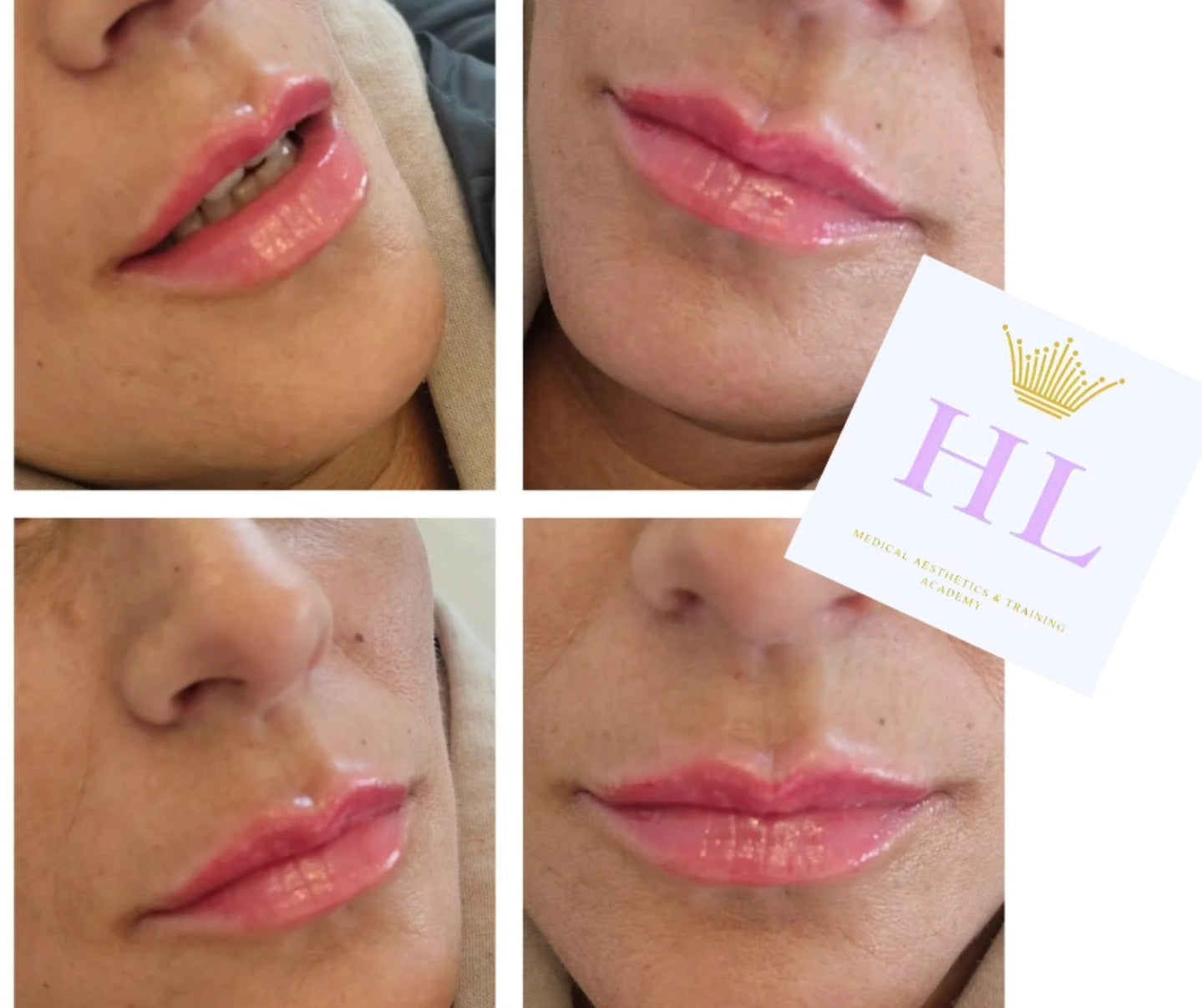 A HL Aesthetics Client in Darlington receiving Lip Filler treatment, showing before and after photos.
