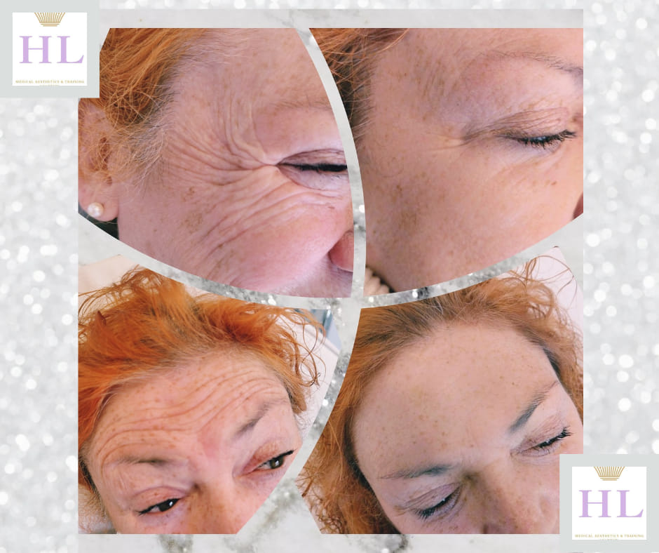 A HL Aesthetics Client in Darlington receiving anti-wrinkle treatment, showing before and after photos.