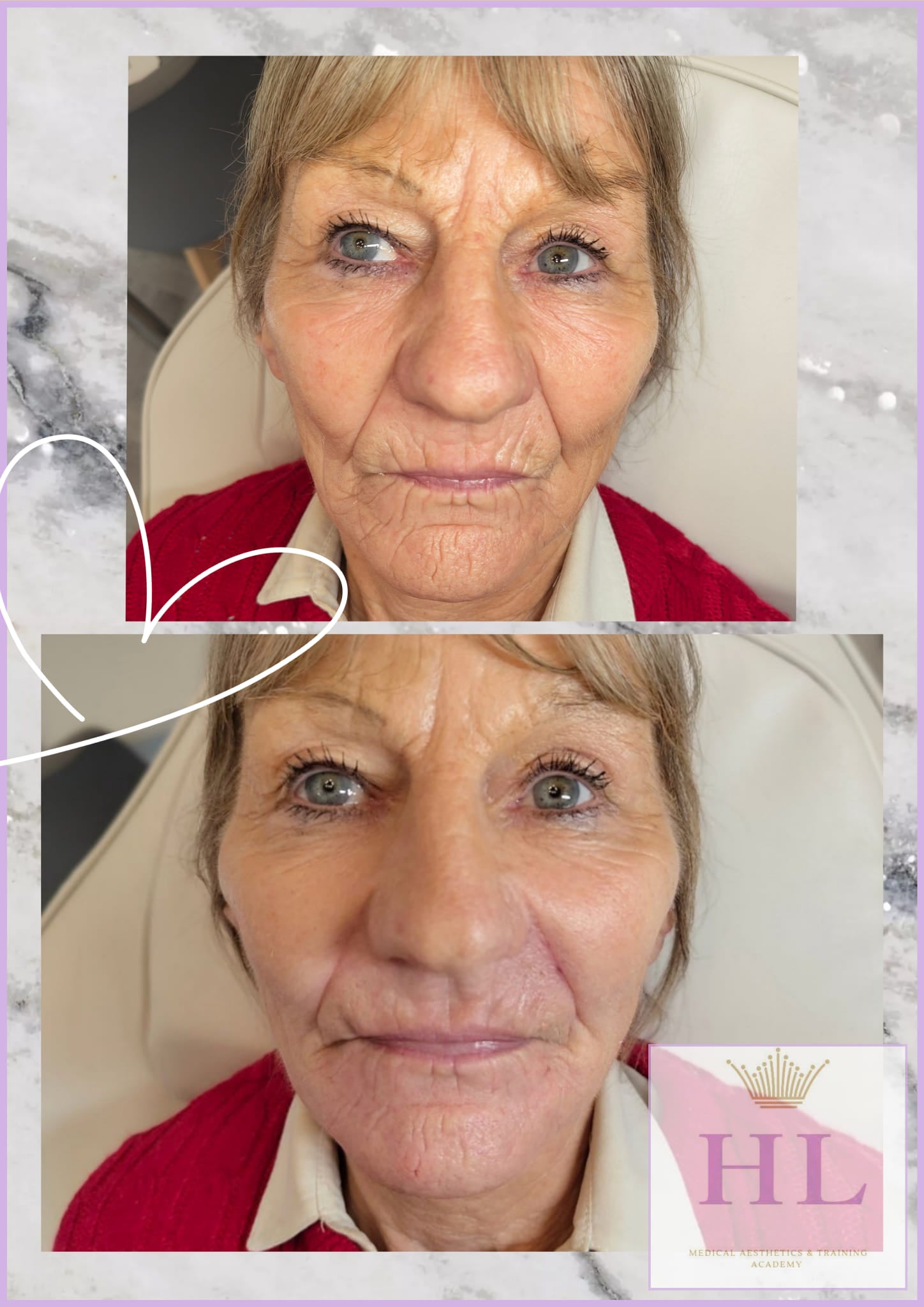 A HL Aesthetics Client in Darlington receiving anti wrinkle treatment, showing before and after photos.