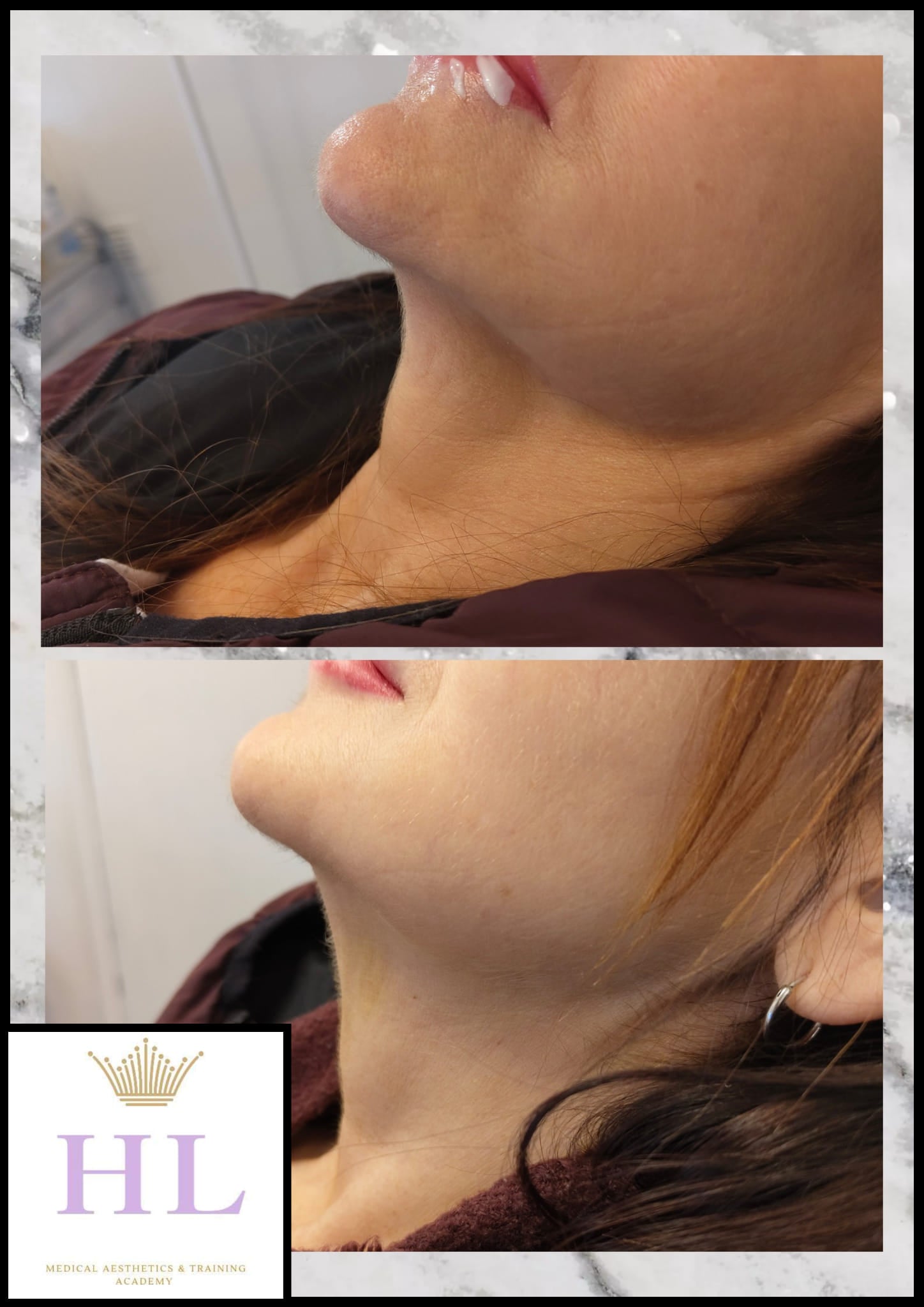 A HL Aesthetics Client in Darlington receiving treatment, showing before and after photos.