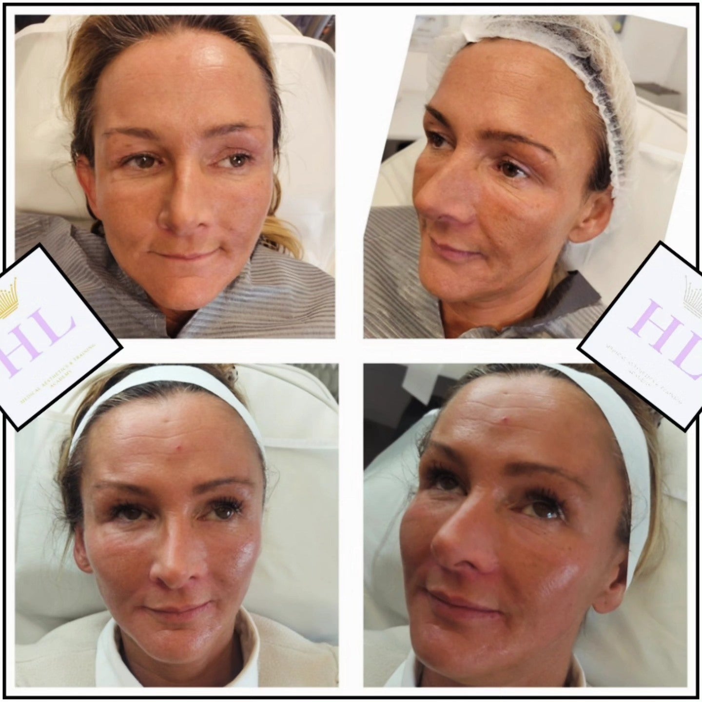 A HL Aesthetics Client in Darlington receiving treatment, showing before and after photos.