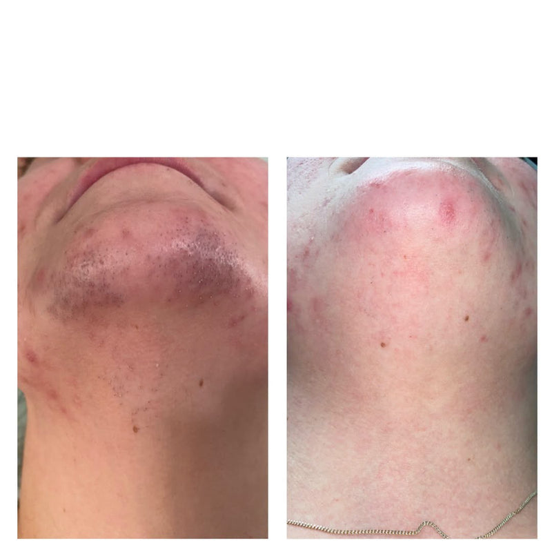 Laser Hair Removal Before & After At HL Medical Aesthetics Darlington